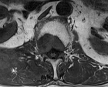 Metastatic Tumour L1 MRI Axial